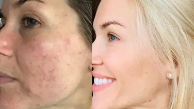 Before and After Results